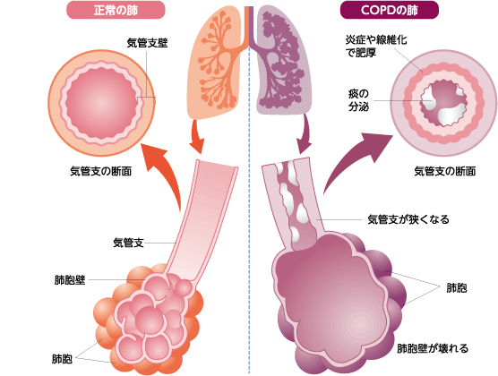 ある ある copd