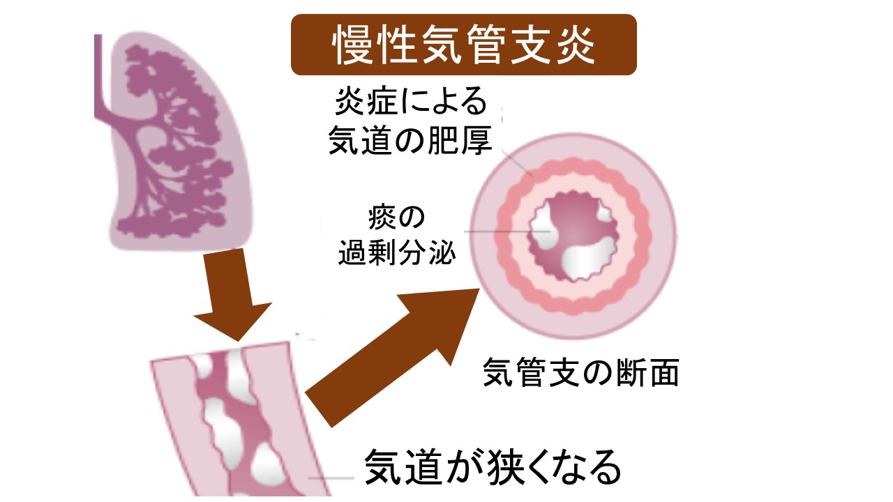 慢性 気管支 炎